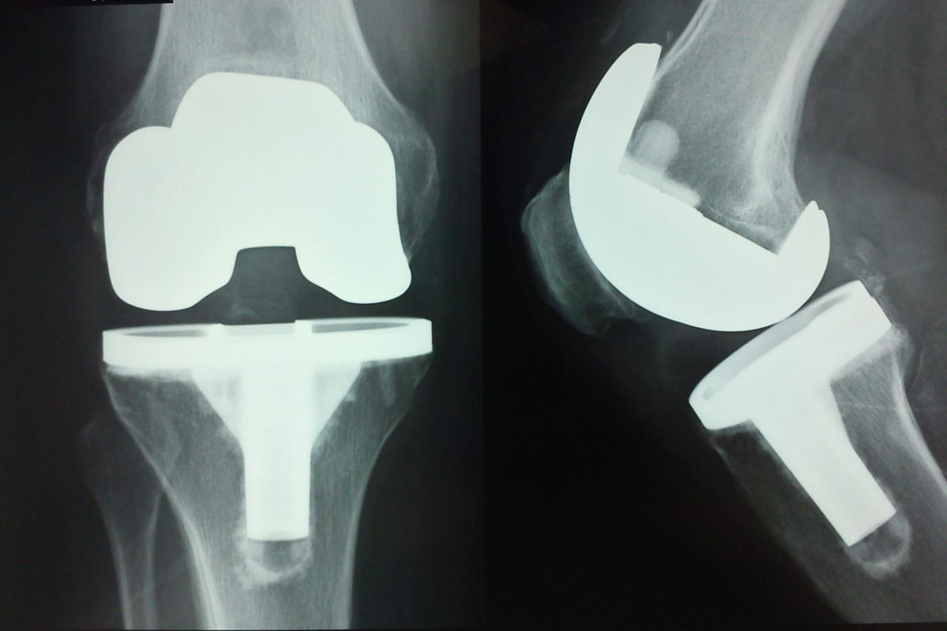 Knee Replacement Pictures 74